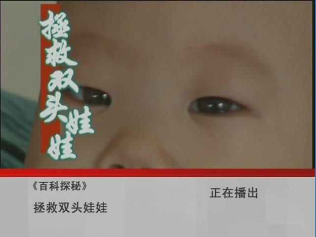 【百科探秘】拯救双头娃娃
